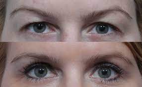 Santa Barbara Eyelid Surgery: A Transformative Journey for Your Eyes post thumbnail image