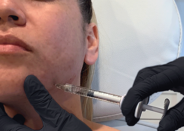 Elevating Skincare Standards: Microneedle RF’s Role in Cosmetic Innovation post thumbnail image