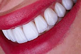 Istanbul Veneer Elegance: Enhance Your Smile with Confidence post thumbnail image