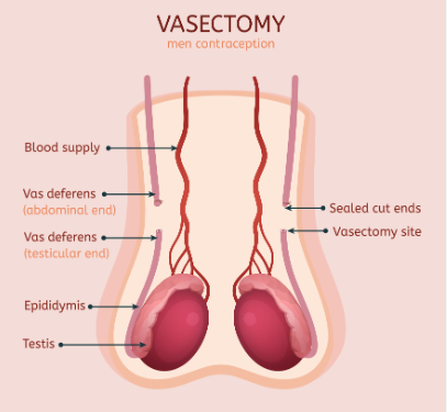 Empowering Choices: Vasectomy Reversal in Saskatoon post thumbnail image