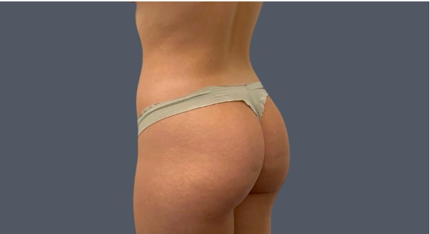 Enhance Your Curves with Brazilian Butt Lift Surgery in Sydney post thumbnail image